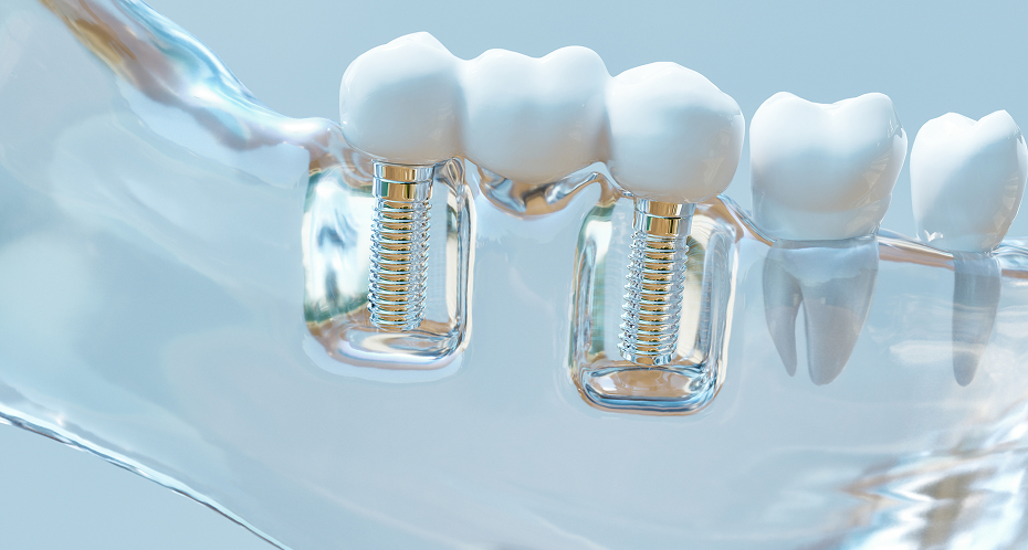 Implants dentaires