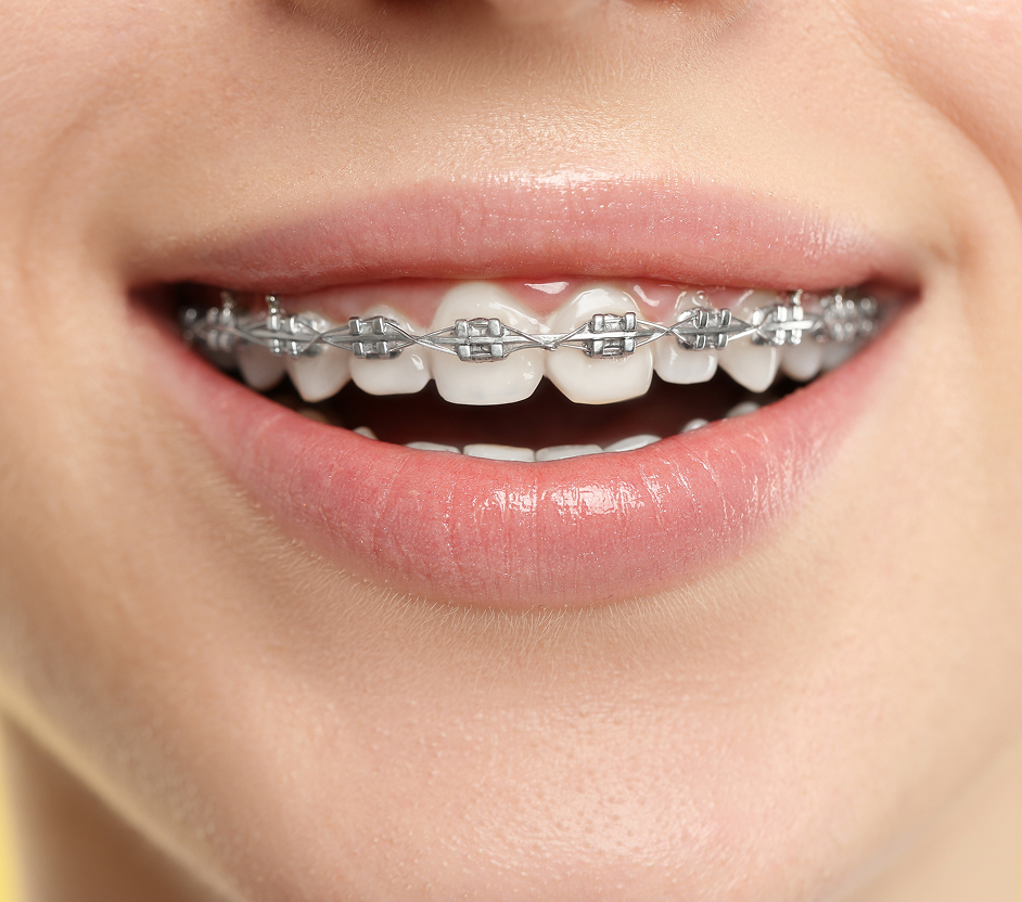 Orthodontie traditionnelle
