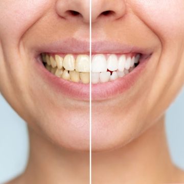 Avant / après montrant les résultats d'un blanchiment des dents sur une femme