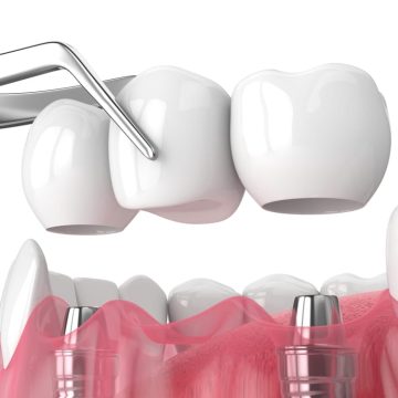 Illustration 3D montrant un pont dentaire sur deux implants dentaires