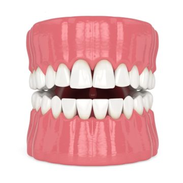 Illustration d'une dentition montrant le concept de triangle noir, ces espace vide entre les dents et la gencive